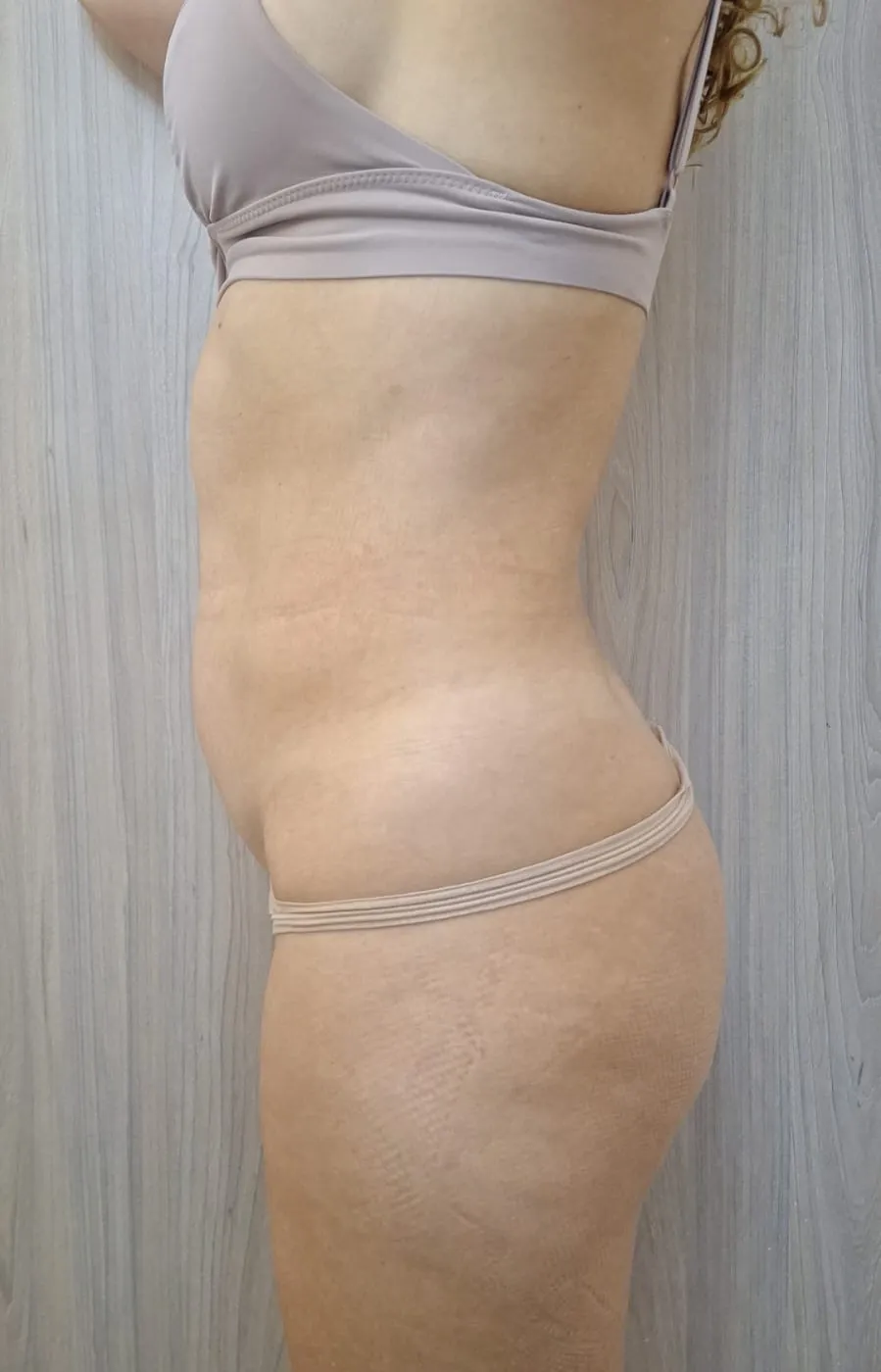 Contorno abdominal previo al protocolo de Lipo Sin Cirugía en sede Escazú.