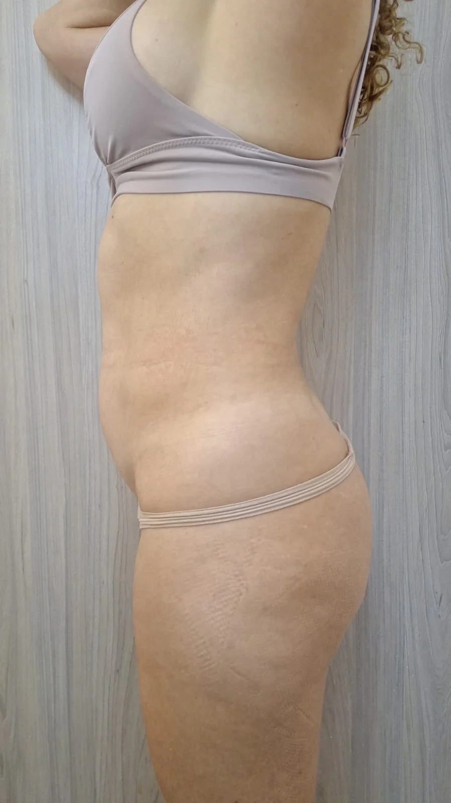 Contorno abdominal previo al protocolo de Lipo Sin Cirugía en sede Escazú.