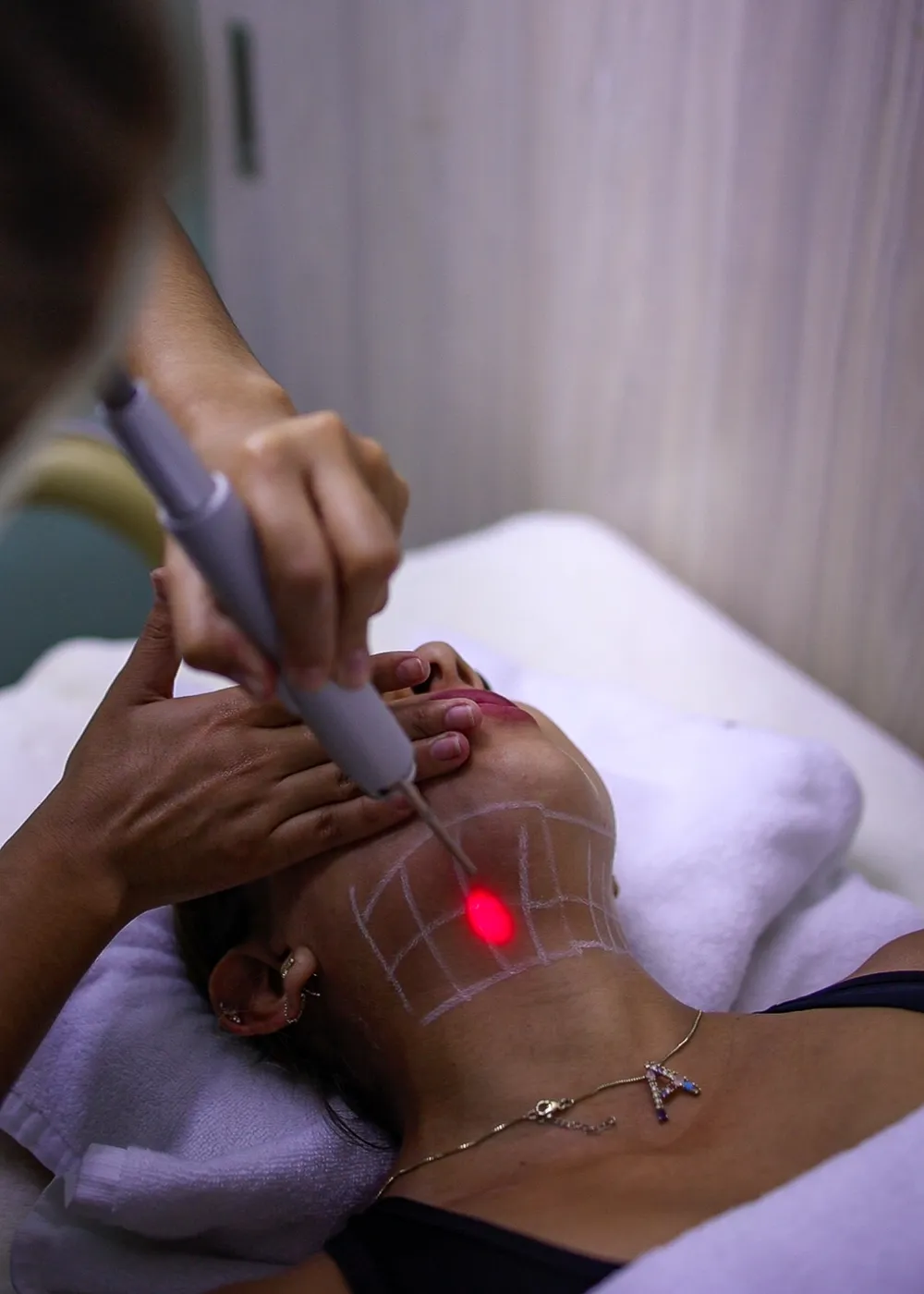 Aplicación de tecnología láser para la redensificación de tejidos y regeneración de colágeno en la zona del cuello y rostro.