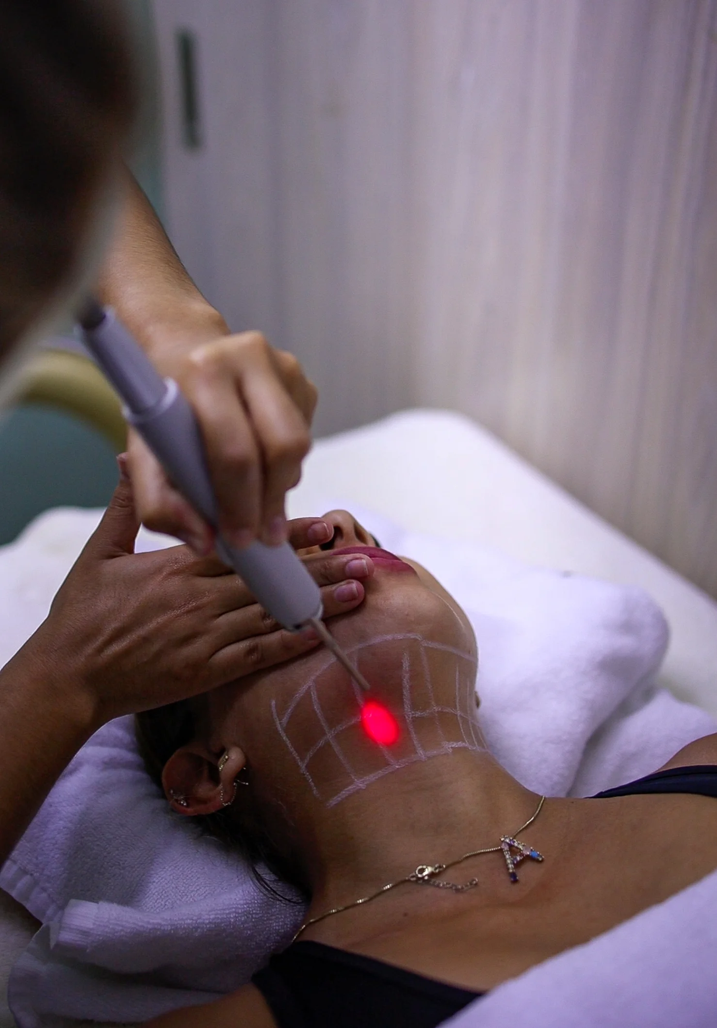 Aplicación de tecnología láser para la redensificación de tejidos y regeneración de colágeno en la zona del cuello y rostro.