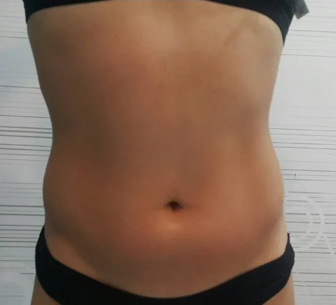Evolución abdominal tras sesiones de Lipo Sin Cirugía: reducción de medidas y definición del contorno corporal.