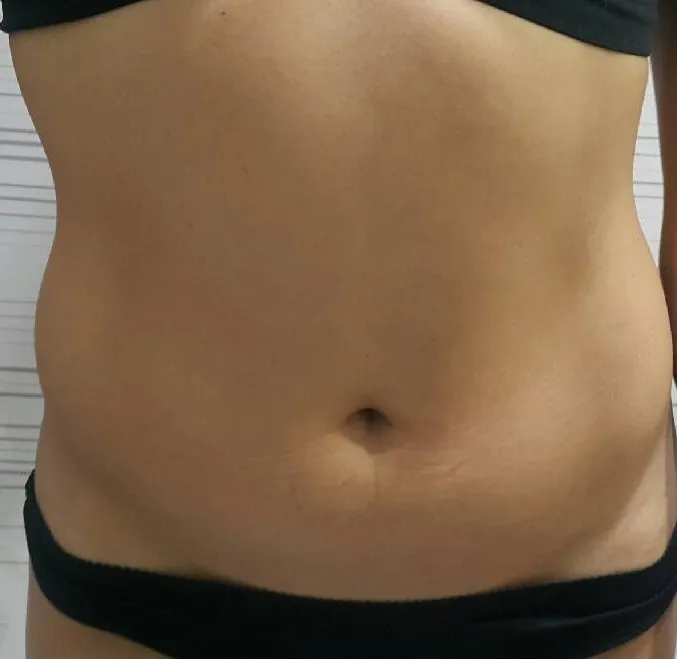 Contorno abdominal previo al protocolo de Lipo Sin Cirugía en sede Escazú.