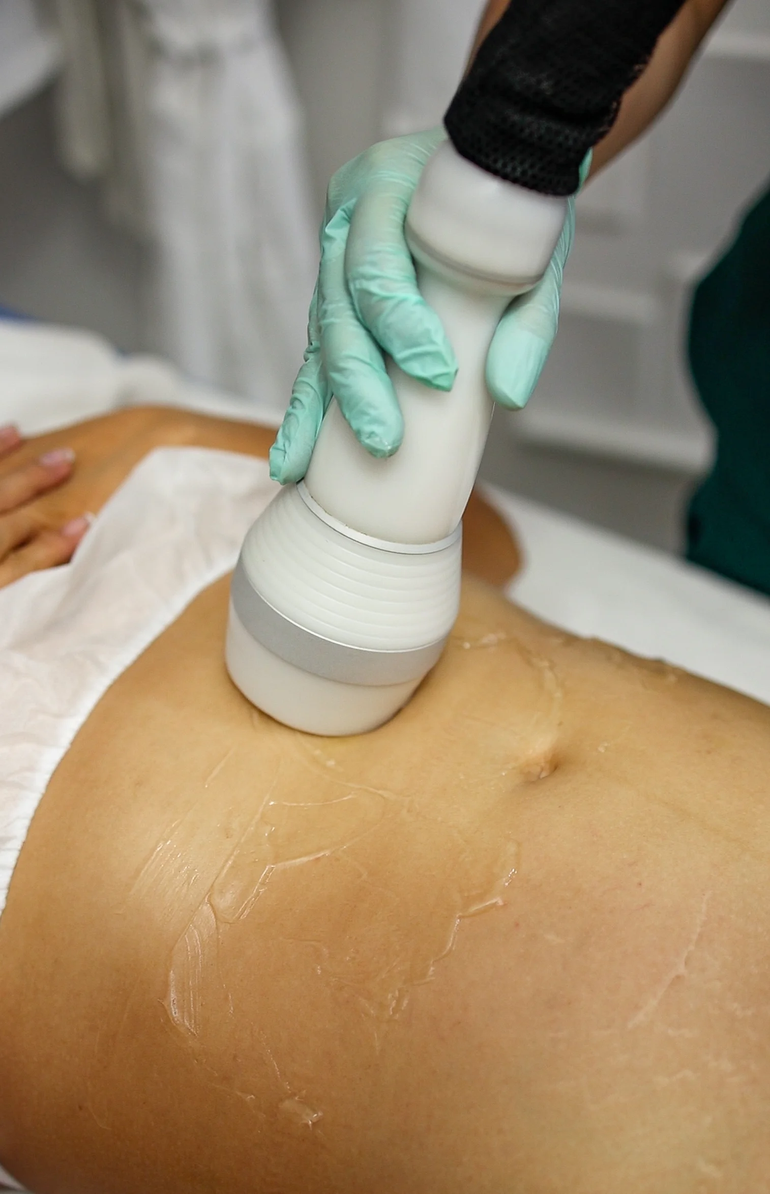 Sesión de aparatología estética de alta precisión sobre la zona abdominal para la eliminación de depósitos adiposos.