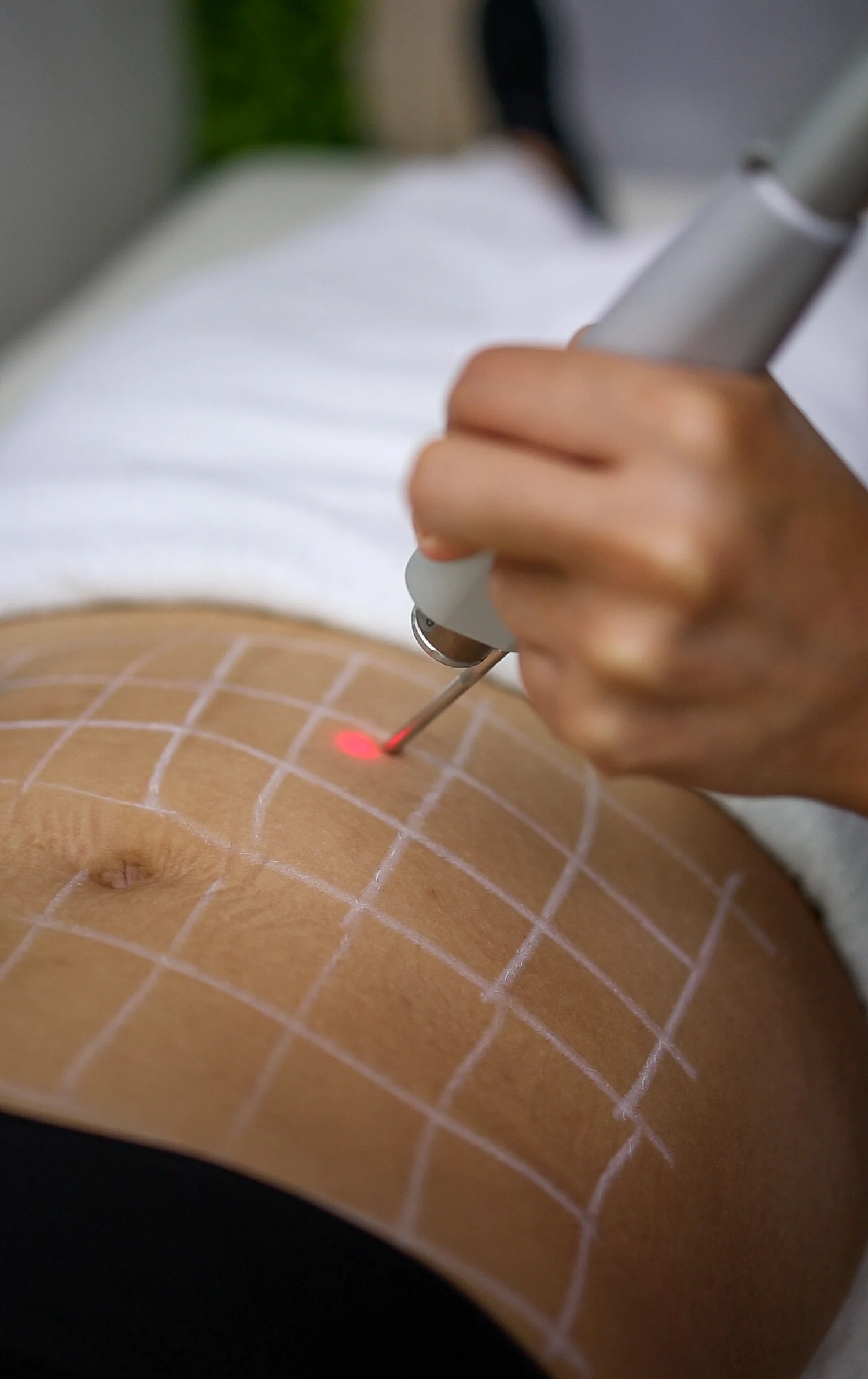 Tensado Laser