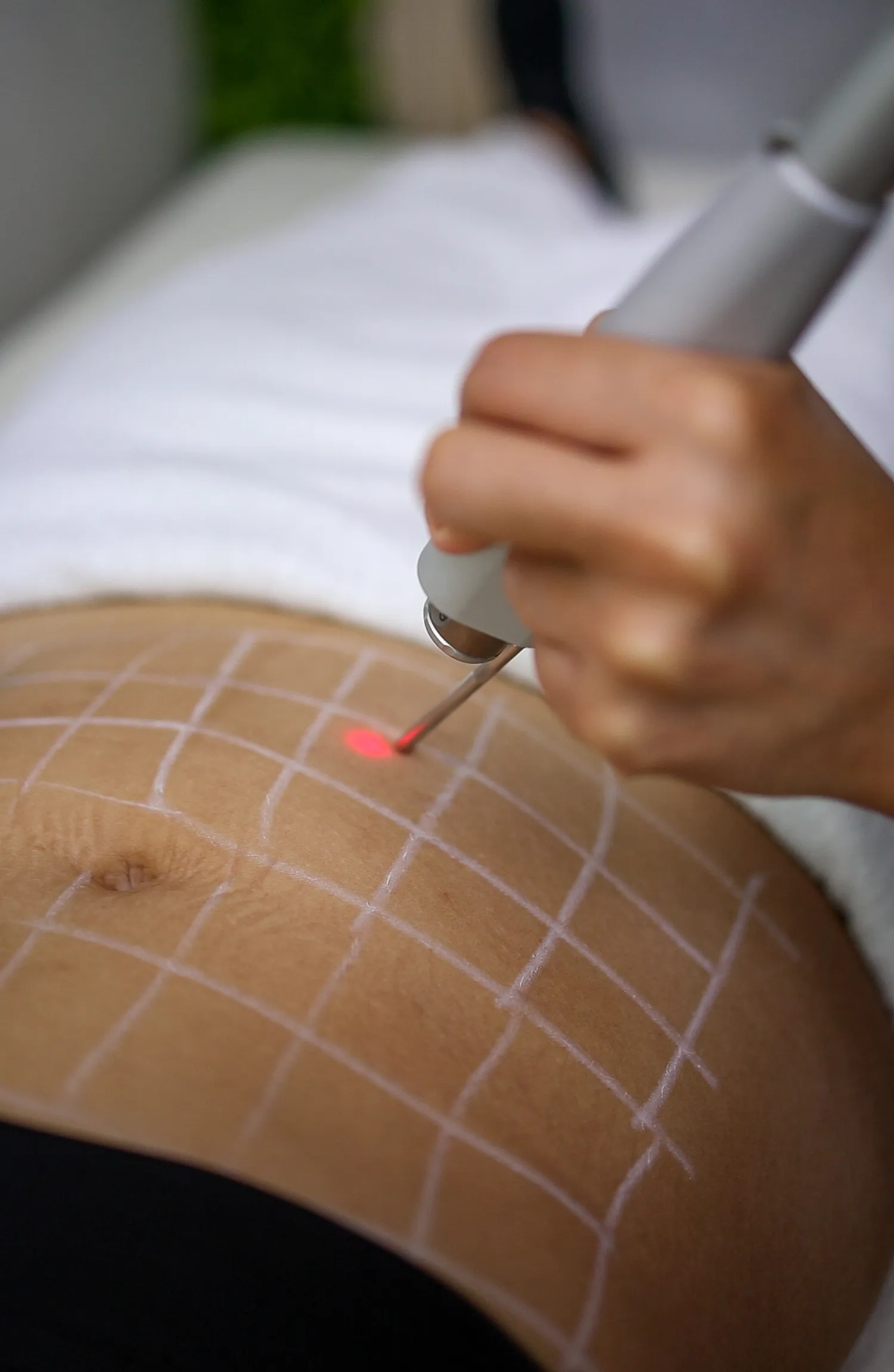 Tensado Laser